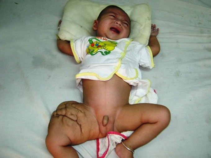 Little baby fighting tumour in leg - 1