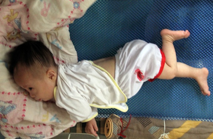 Malnourished baby fighting heart disease to survive - 2 Malnourished baby fighting heart disease to survive - 2