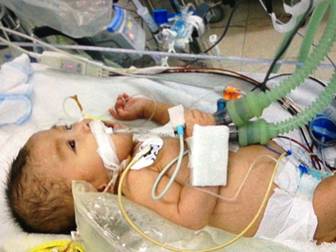 Little baby struggles with congenital heart disease - 1
