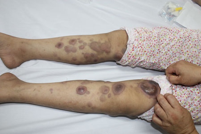 Poor mother seeking community to save daughter with leukemia - 2 Poor mother seeking community to save daughter with leukemia - 2