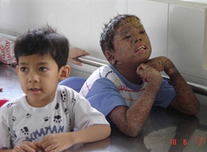 UK MPs raise funds for Vietnamese AO victims - 1 UK MPs raise funds for Vietnamese AO victims - 1