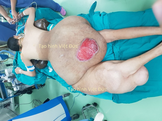 Doctors remove a giant 23kg tumour from man's backside - 1