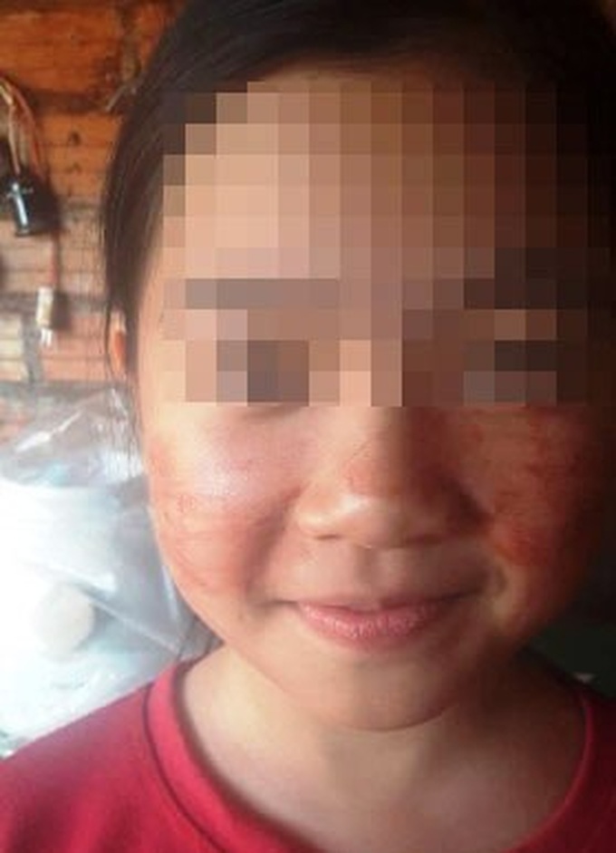 Girl in Gia Lai suffers from bloody sweating - 1