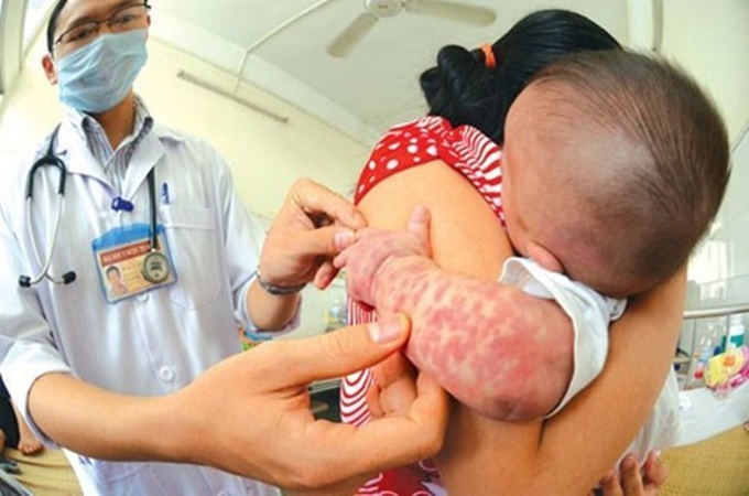 Hanoi conference tackles measles crisis - 1