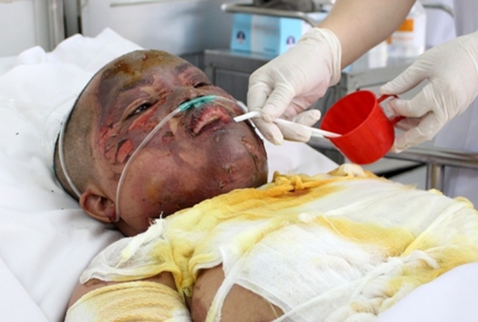 Seriously burnt woman issues plea for help - 1