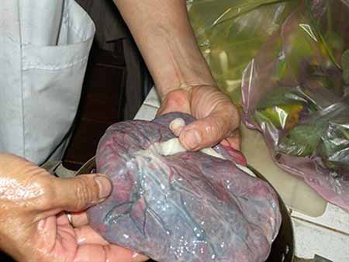 Human placenta floods medicine market - 1