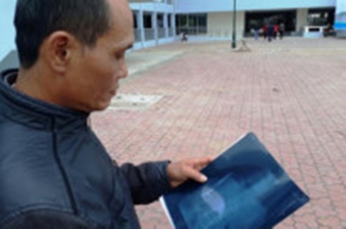 Scissors found in man's abdomen after 18 years - 1