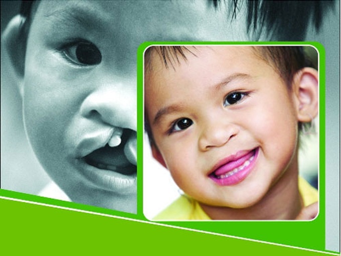 Operation Smile to raise funds for 500 surgeries - 1