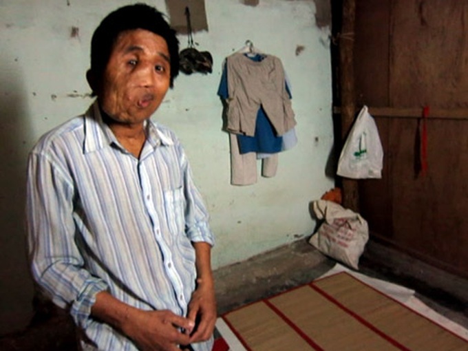 Misfortunes of man with facial deformities - 2