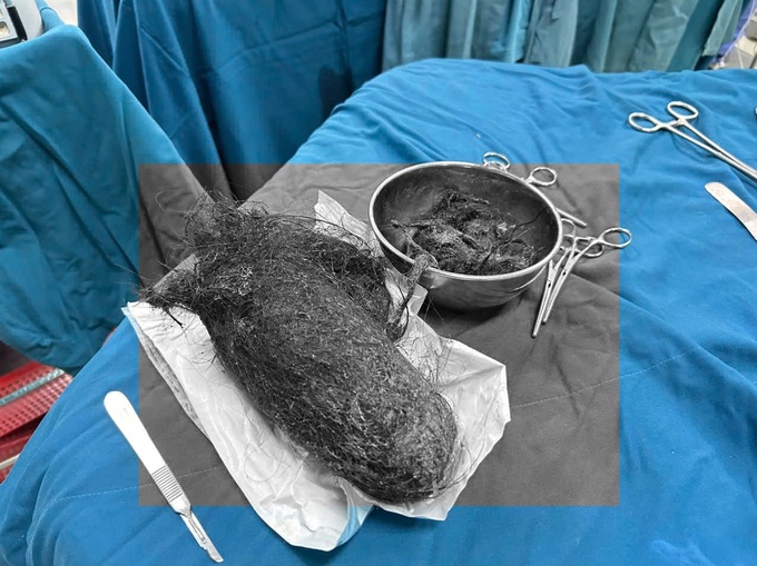 12-year-old girl has massive hairball surgically removed from stomach - 1