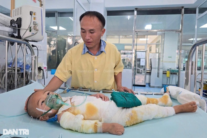 Dien Bien burn victim boy receives over VND 322 million in donations - 1 Dien Bien burn victim boy receives over VND 322 million in donations - 1