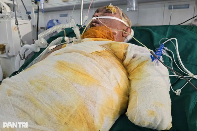 Young man with severe burns receives USD 22,600 in support for treatment - 2 Young man with severe burns receives USD 22,600 in support for treatment - 2