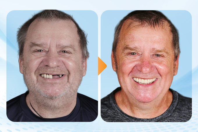 Digital implant expertise brings overseas patients  to Dr. Care HCM City - 3