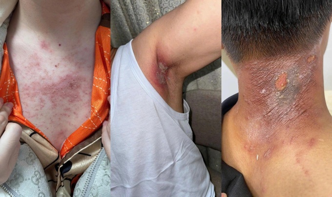 Hanoi doctors warn of skin damage from rove beetles - 1