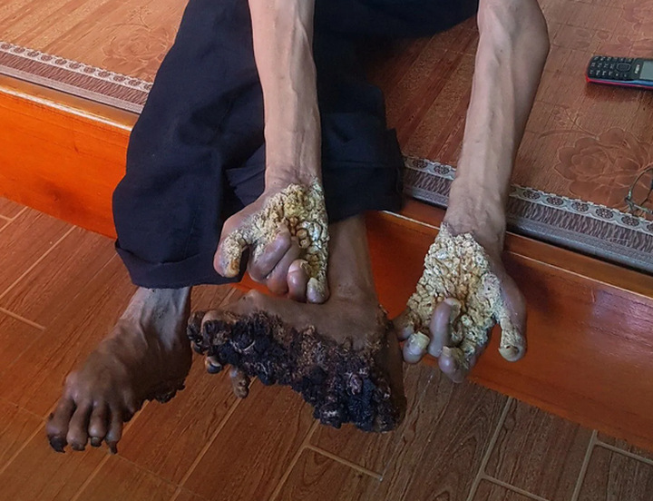 Two treeman syndrome cases reported in Vietnam - 1
