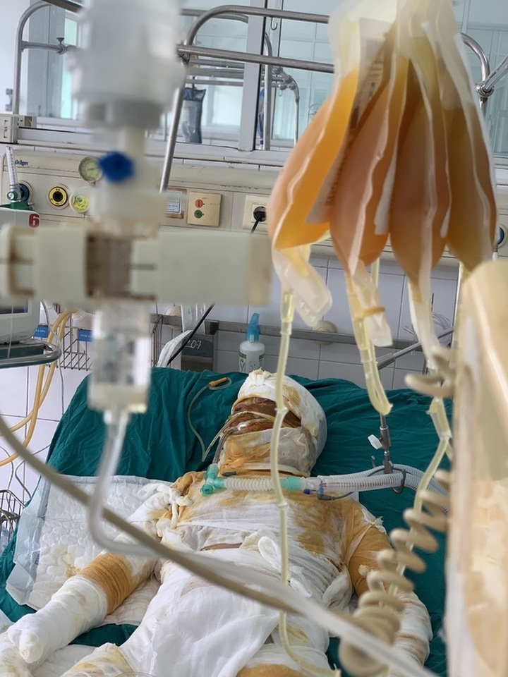 Burn victims in desperate need of help to survive - 2 Burn victims in desperate need of help to survive - 2