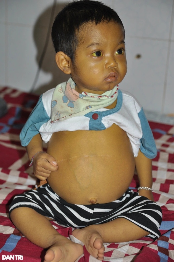 Poor boy receives support for liver transplant - 1