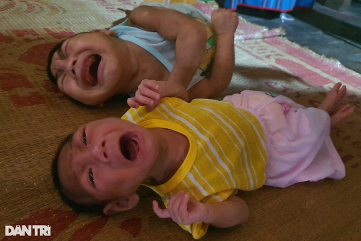 Dantri/DTiNews readers help two children suffering from brain atrophy - 1