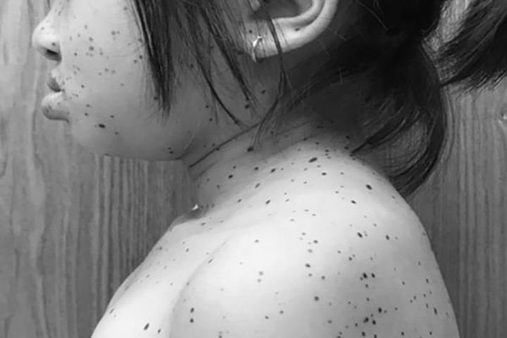 Vietnam reports first Leopard Syndrome case - 1 Vietnam reports first Leopard Syndrome case - 1