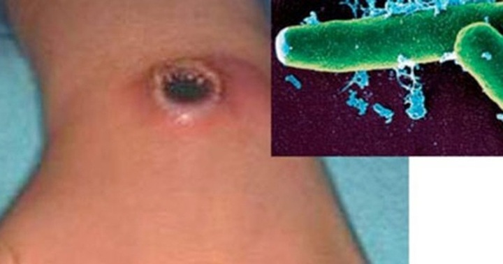 Dien Bien faces anthrax outbreak - 1