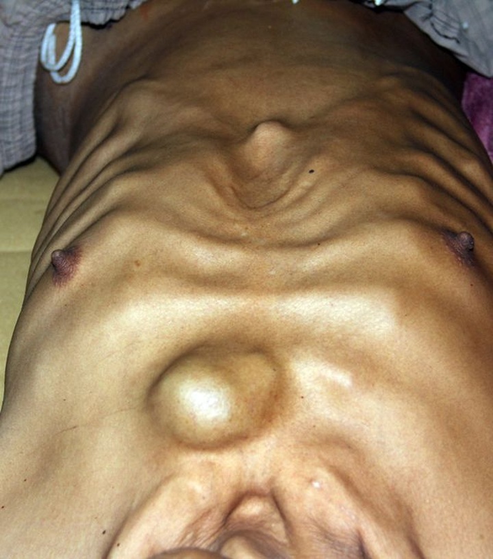 Man struggling with osteoma needs help - 2 Man struggling with osteoma needs help - 2