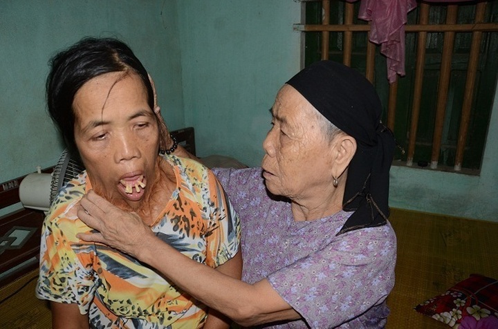 Woman suffering from horrific facial burns has life-transforming operation - 6 Woman suffering from horrific facial burns has life-transforming operation - 6