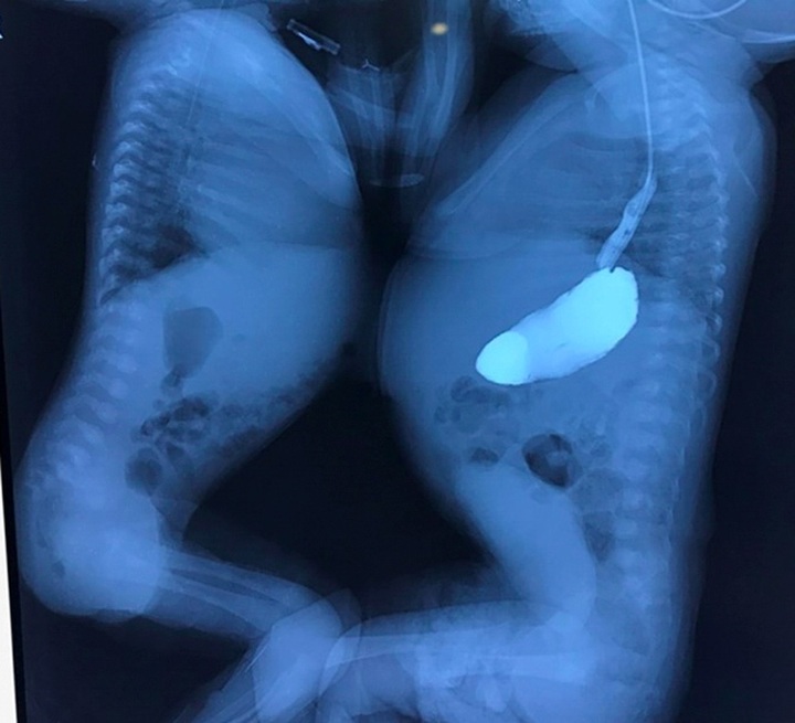 Conjoined twins to undergo separation surgery - 1