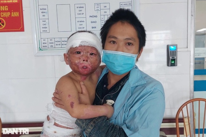 Dantri/DTiNews readers support seriously-burnt little girl - 1