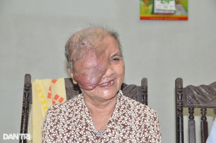 Woman receives support to remove disfiguring facial tumour - 2