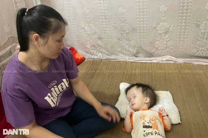 Little girl suffering from hydrocephalus needs help - 1 Little girl suffering from hydrocephalus needs help - 1