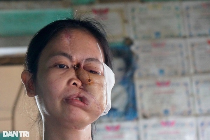 Poor woman receives public help to treat deformed face - 2 Poor woman receives public help to treat deformed face - 2