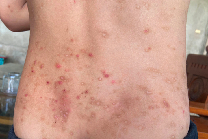 Insects blamed for skin disease outbreak in Ha Tinh - 1