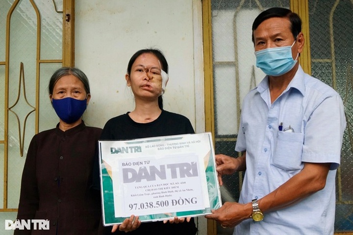 Poor woman receives public help to treat deformed face - 1 Poor woman receives public help to treat deformed face - 1