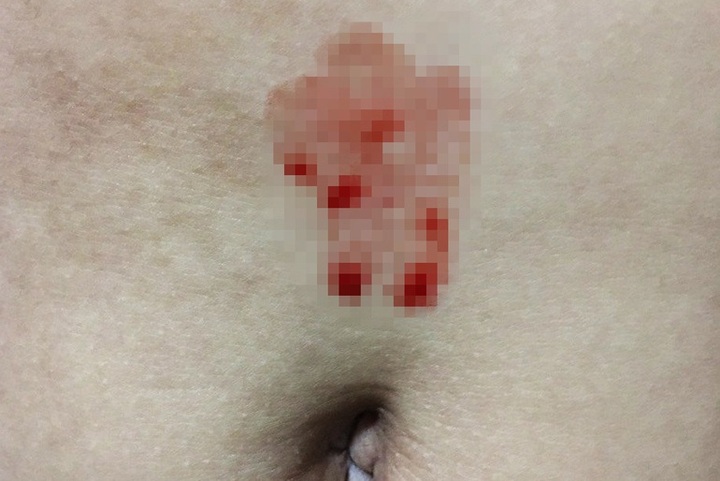 Girl suffers ‘blood sweating’ after social distancing anxiety - 1