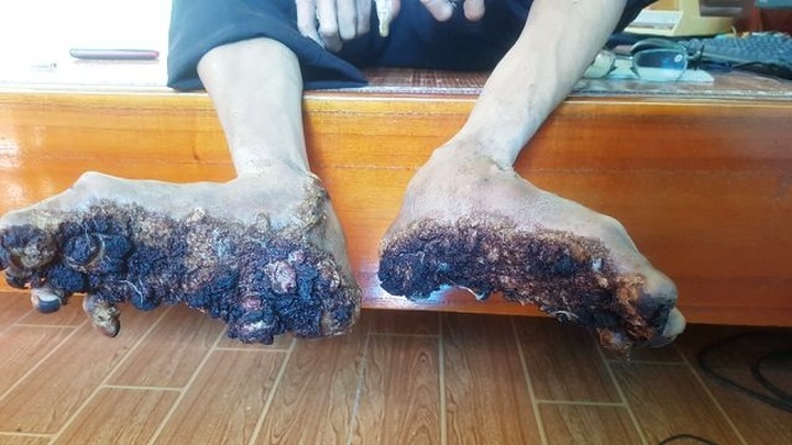 Two treeman syndrome cases reported in Vietnam - 2