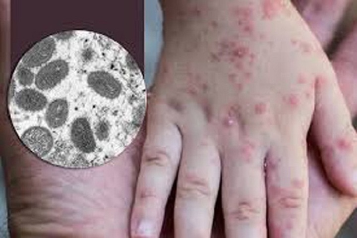 Woman returning from Dubai tests positive for monkeypox - 1 Woman returning from Dubai tests positive for monkeypox - 1