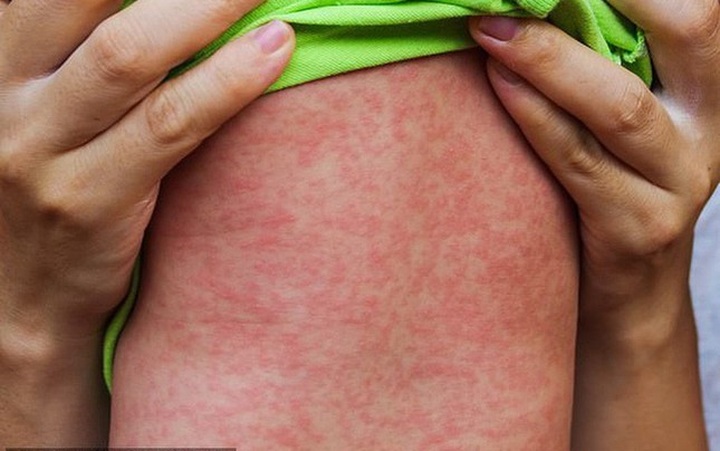 Ministry asks for preparation of measles outbreak - 1