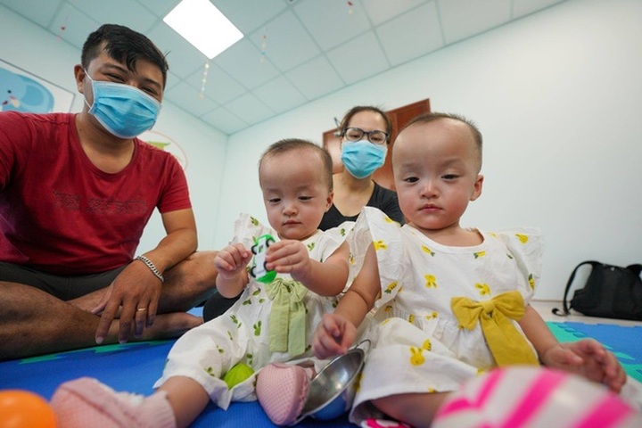 Con-joined twins successfully separated discharged from hospital - 1