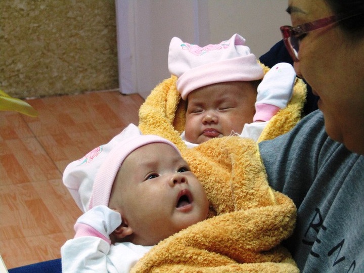 Conjoined twins discharged from hospital after surgery - 2