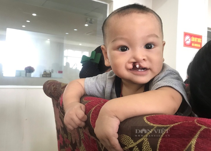 Free check-ups and operations for hundreds of children with cleft lips and palates - 3