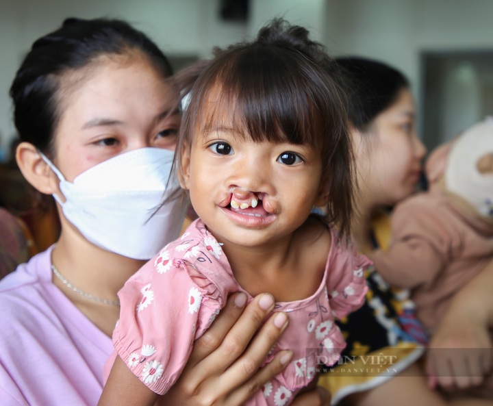 Free check-ups and operations for hundreds of children with cleft lips and palates - 2