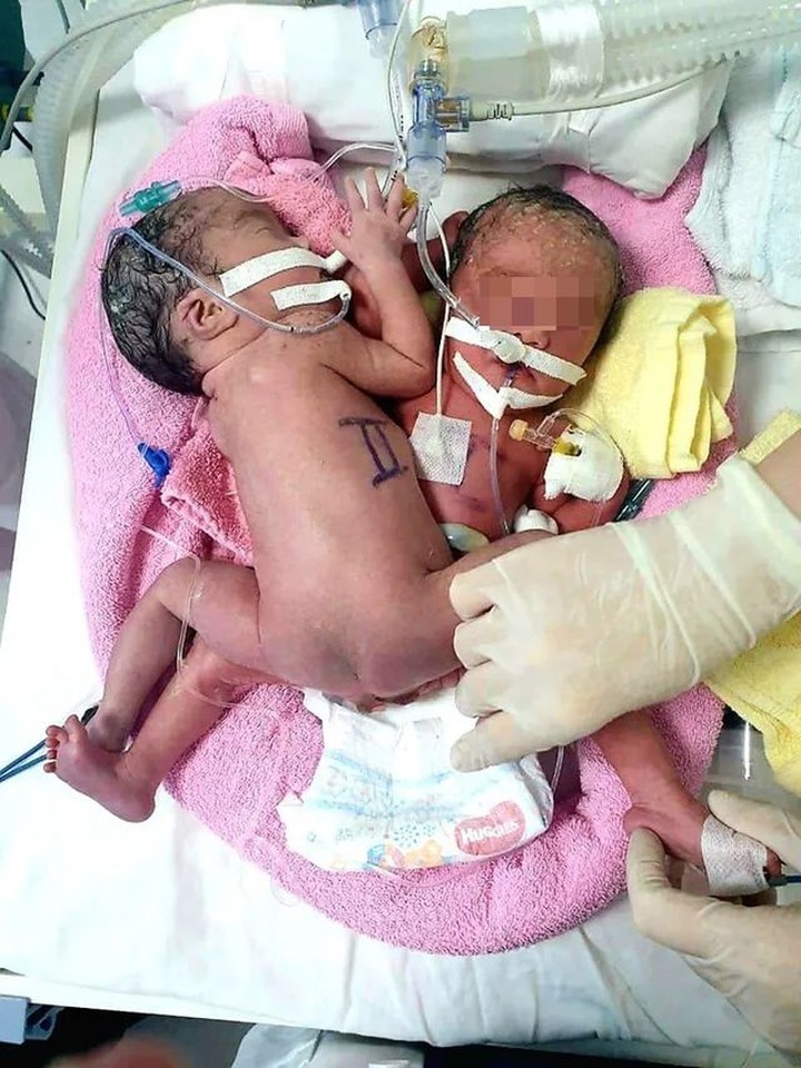 HCM City doctors seek to separate conjoined twins - 1 HCM City doctors seek to separate conjoined twins - 1