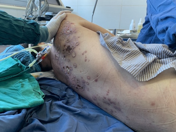 Woman desperately calls for help after being infected with staphylococcus aureus - 2 Woman desperately calls for help after being infected with staphylococcus aureus - 2