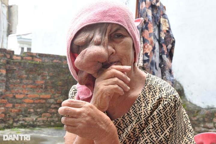 Woman with disfiguring facial tumour needs help - 1