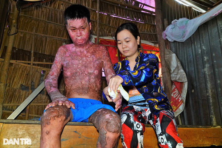 Seriously-burnt man in Hau Giang in desperate need of support - 1