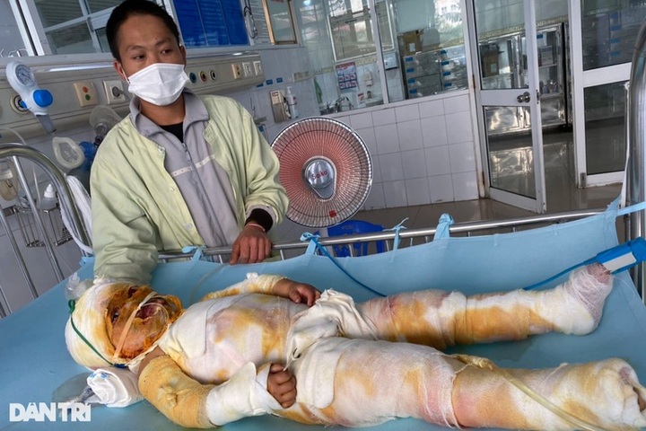 Little girl facing serious burns in dire need of help - 2