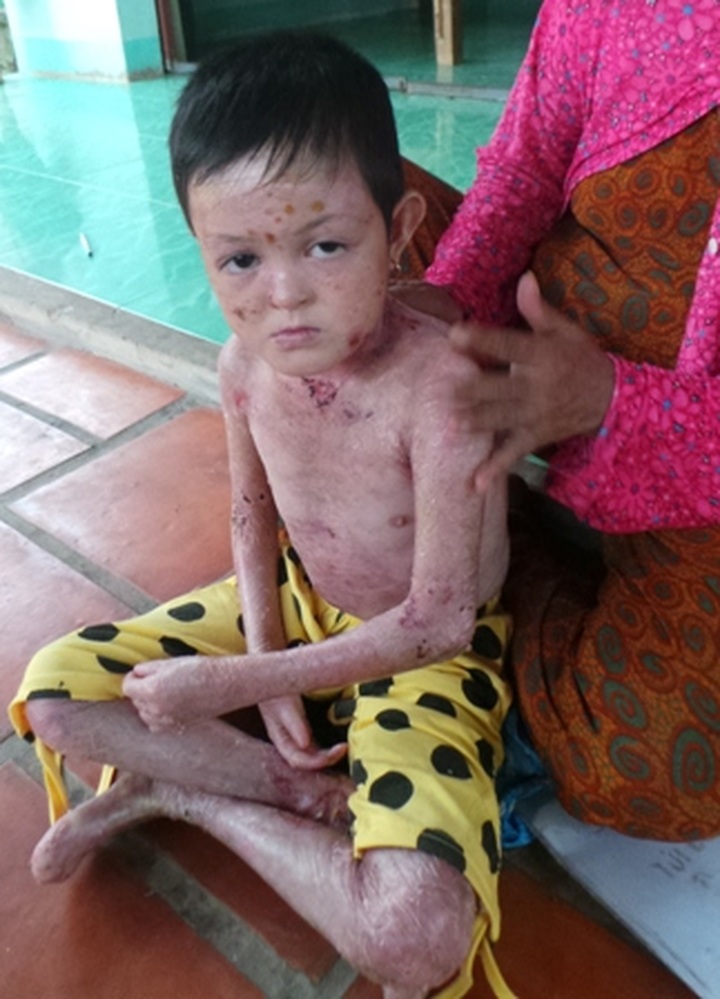 Little 'butterfly child' fights rare skin disease - 2