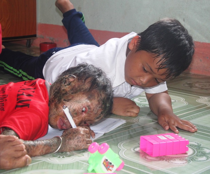 DTiNews readers support little girl with serious skin disease - 1