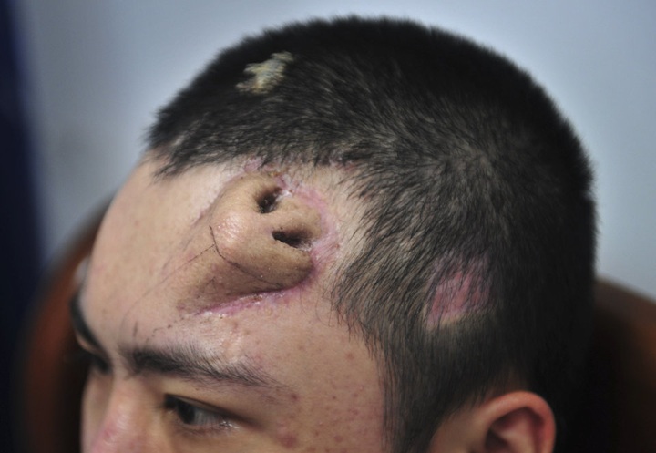 Chinese doctor builds new nose on man's forehead - 1