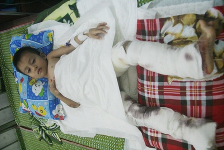 Burn victims seek help from community - 2